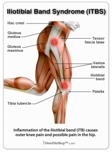 Iliotibial Band Syndrome (ITBS), liac crest, Gluteus medius, Tensor fascia latae, Gluteus maximus,Vastus lateralis, Iliotibial band, Tibia tubercle, Patella, Inflammation of the iliotibial band (ITB) causes outer knee pain and possible pain in the hip, MendMeShop TM ©2011